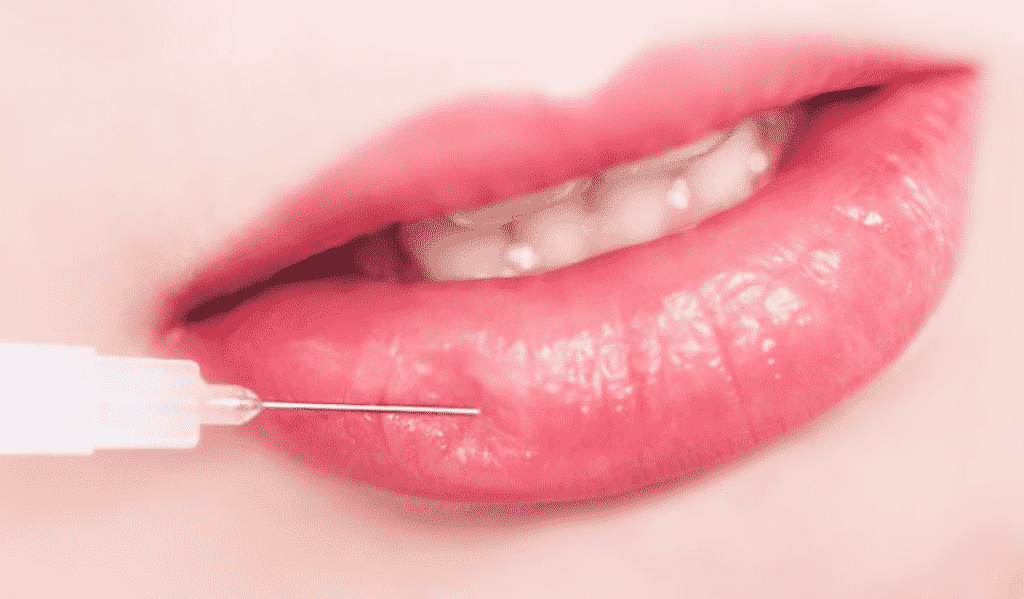 ALL ABOUT LIP FILLER and how to tell if you'll look ducky