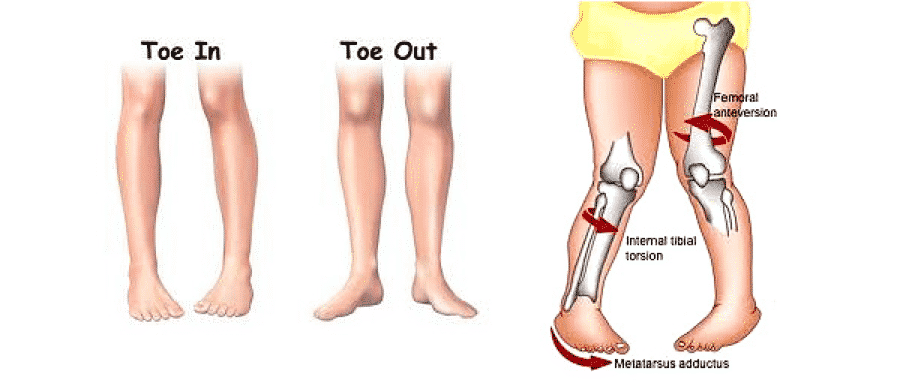 in toe, out toe condition and how to treat it