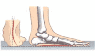 ankle pronation in kids feet, feet turn inwards