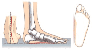 flat foot in children how to recognize it