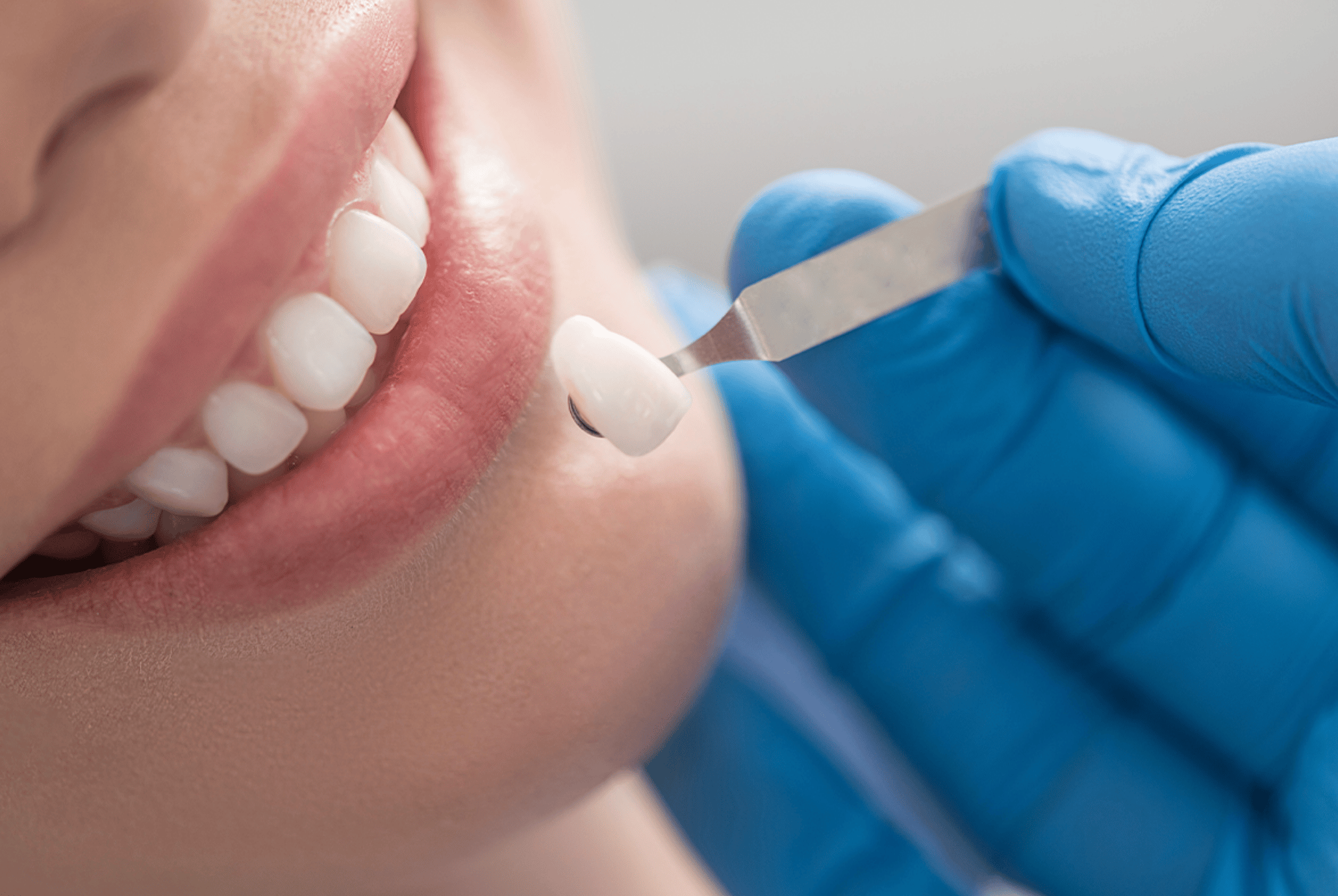 Should I Get Veneers Or Crowns?