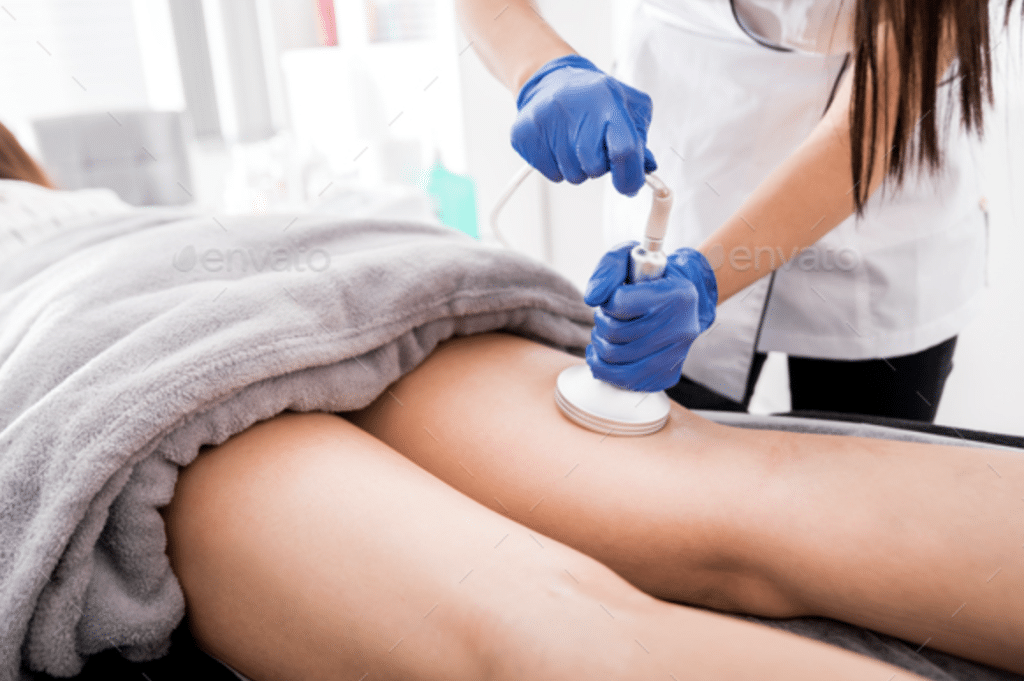 Whispers of Expertise: Navigating Cellulite Treatment