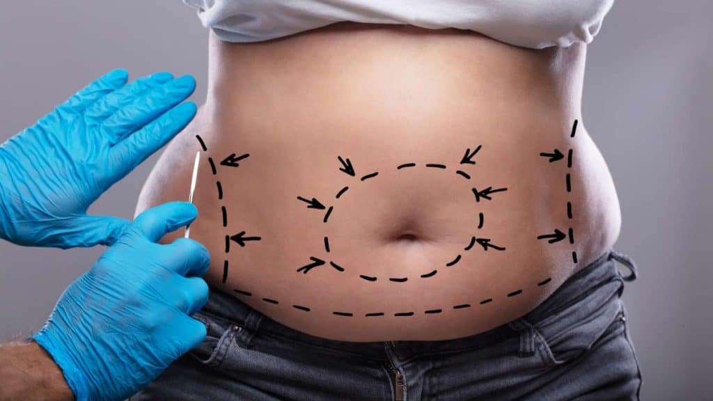 Tummy Tuck Surgery Explained_ Types and Truths