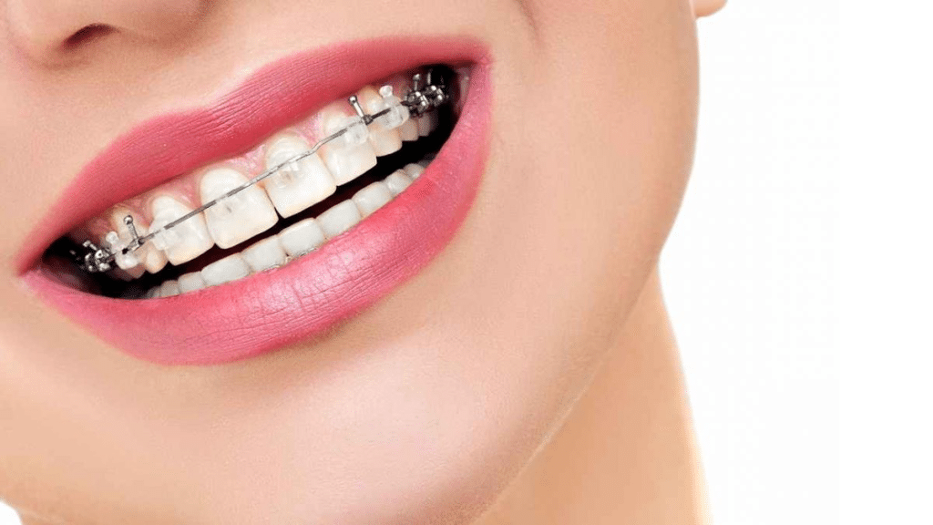 Perfecting Smiles at McAllister Orthodontics