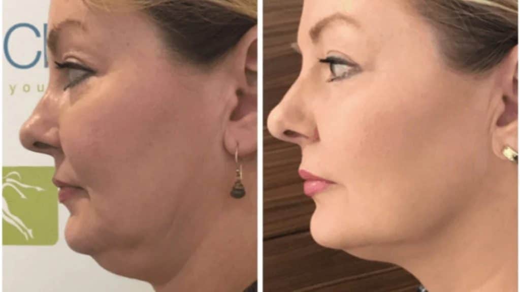 The Benefits of HIFU Face Lifting