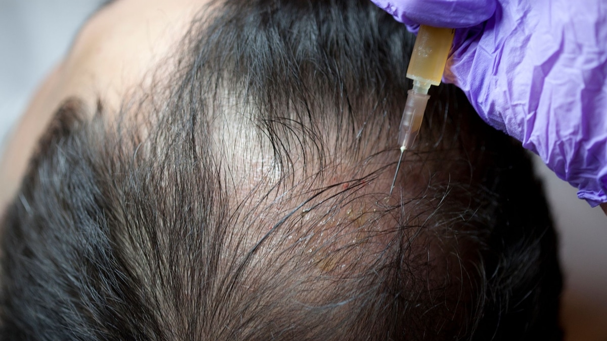 Top 5 Reasons To Choose Prp Hair Loss Treatment: From Safety To Efficacy