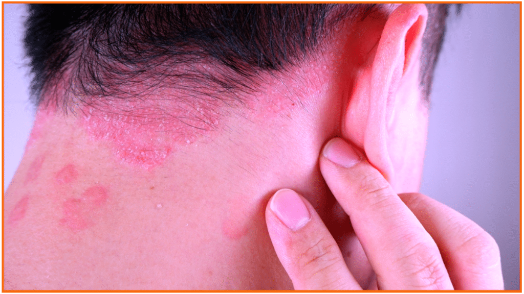 What are the Treatment Options for Psoriasis