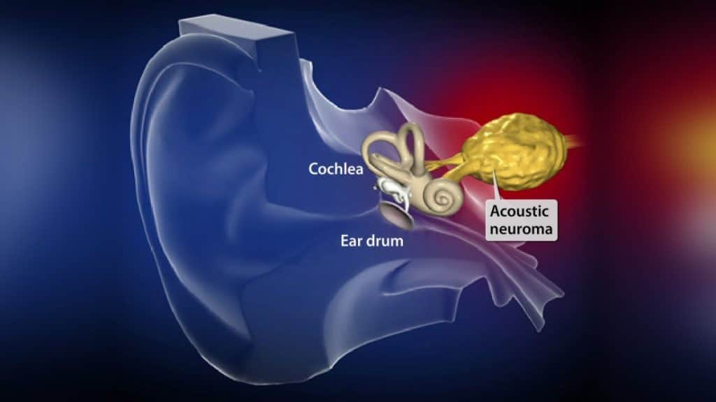 Acoustic Neuroma Symptoms, Causes, and Treatment