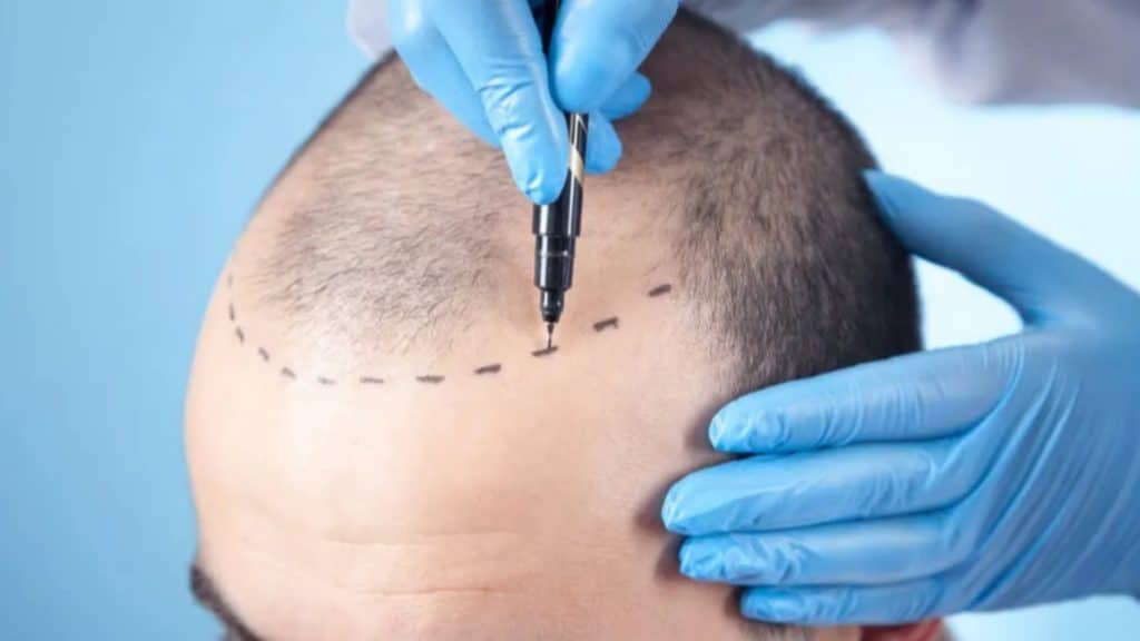 The Rise of Medical Tourism Exploring the Allure of Hair Transplants in Turkey