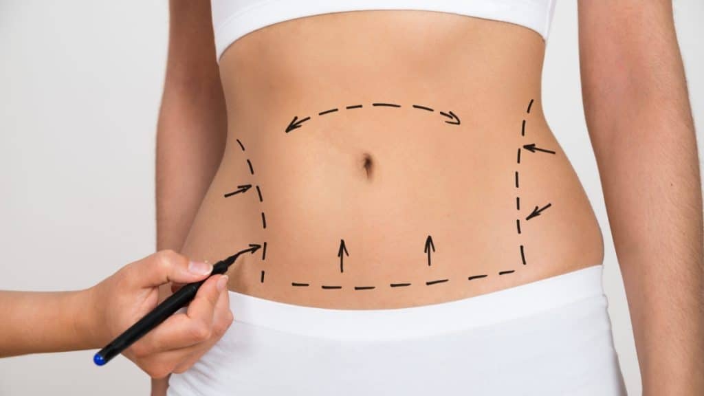 Achieving a Smaller Waist with Tummy Tuck Surgery