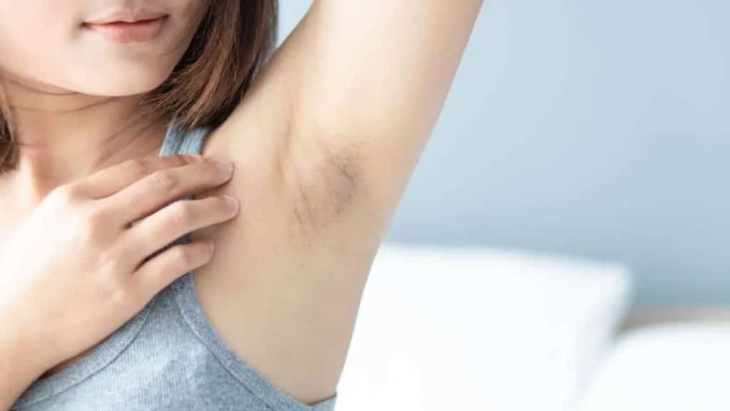 Dark Underarms Treatment, Causes, and Prevention