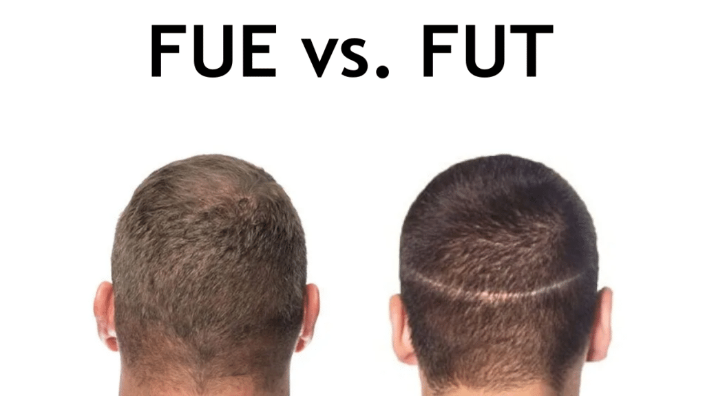 FUE vs. FUT Factors to Consider When Choosing a Hair Transplant Method