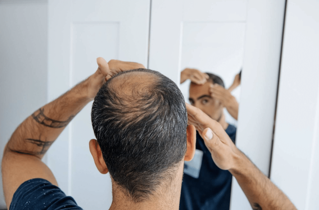 Hair Transplants vs. Other Hair Loss Treatments: What’s the Best Option?