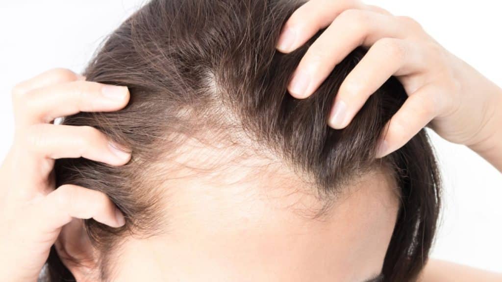 How to Regain Confidence Despite Hair Loss