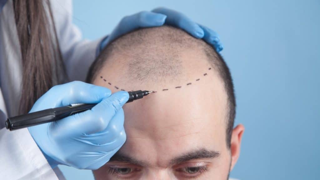 5 Reasons to Get a Hair Transplant in Turkey