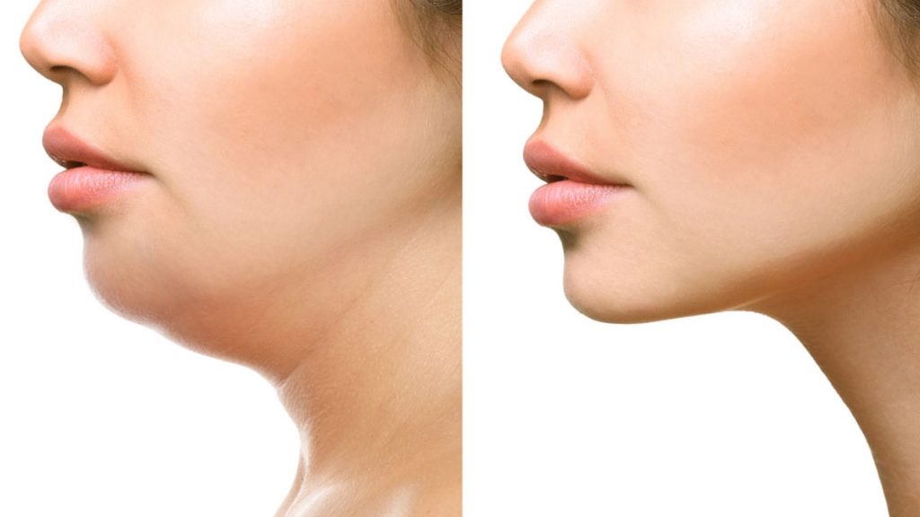 What to Expect During and After Your Chin CoolSculpting Procedure