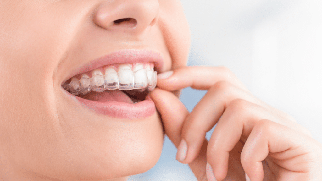 A Complete Guide to Invisalign Treatment in Riverdale, NY