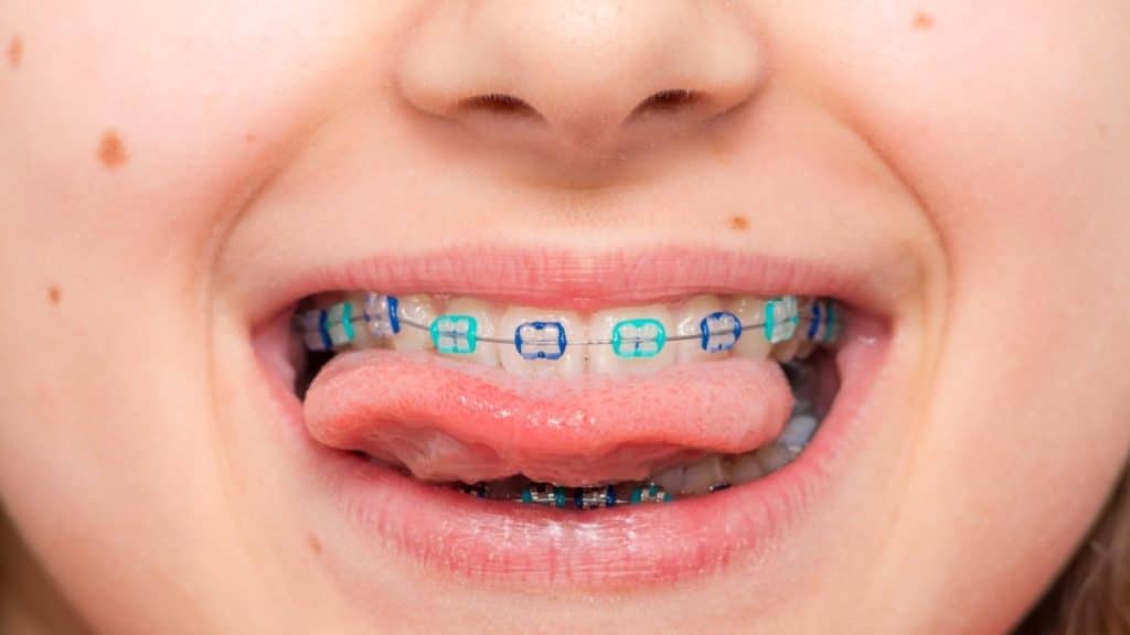 A Parent’s Guide to Preparing Your Child for Braces