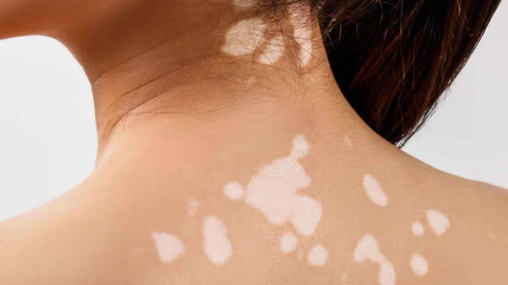 Causes of Skin Discoloration