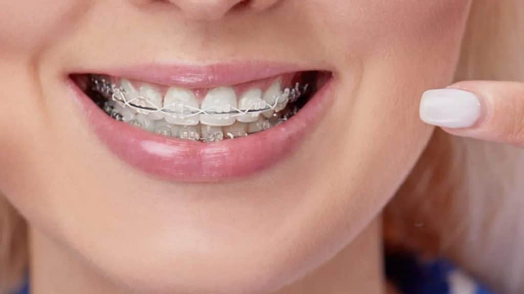 Tips for a Smooth Braces Experience in Moorestown, NJ