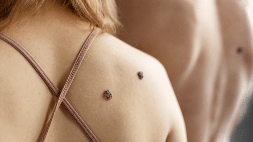 What Are Skin Moles? Types, Causes, and More