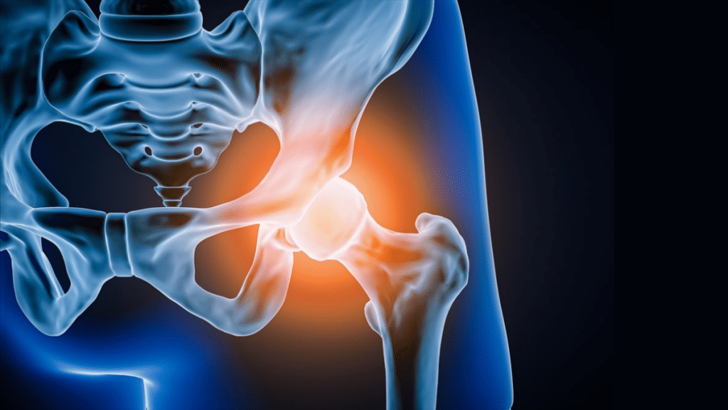 Cost-Effective Hip Replacement Surgery In Delhi