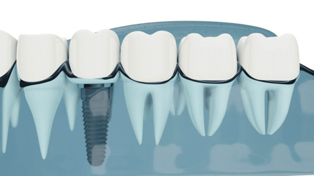 Everything You Need to Know About Dental Implants Materials, Pros and Cons, and Interesting Facts