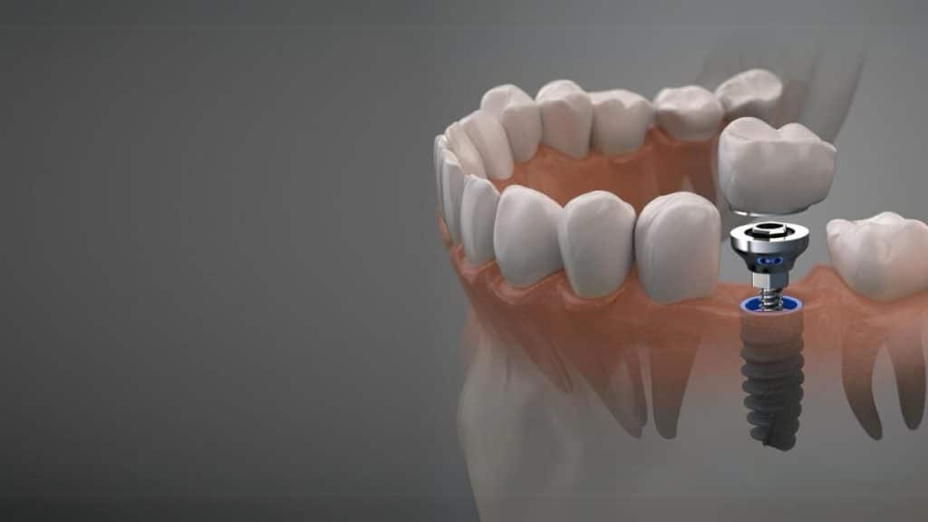 How Dental Implants can help you Live Better Life