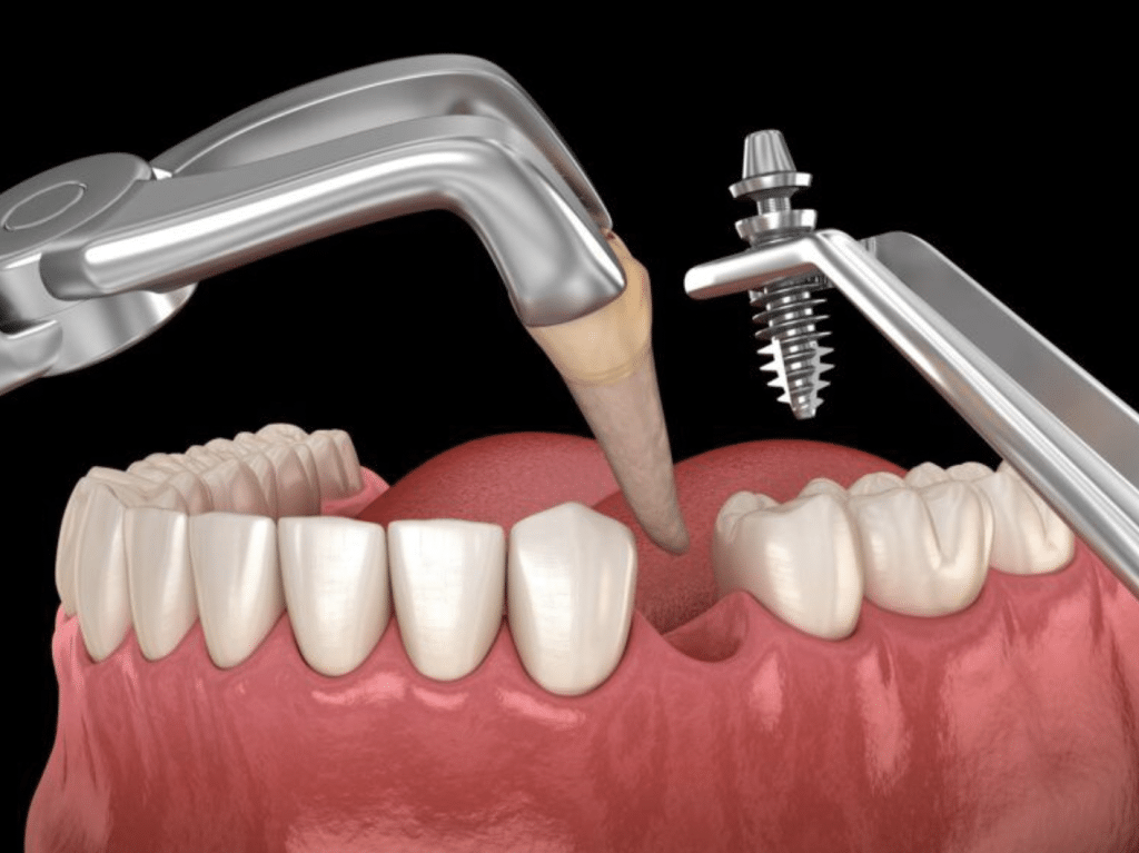 Immediate Vs Delayed Dental Implant Placement