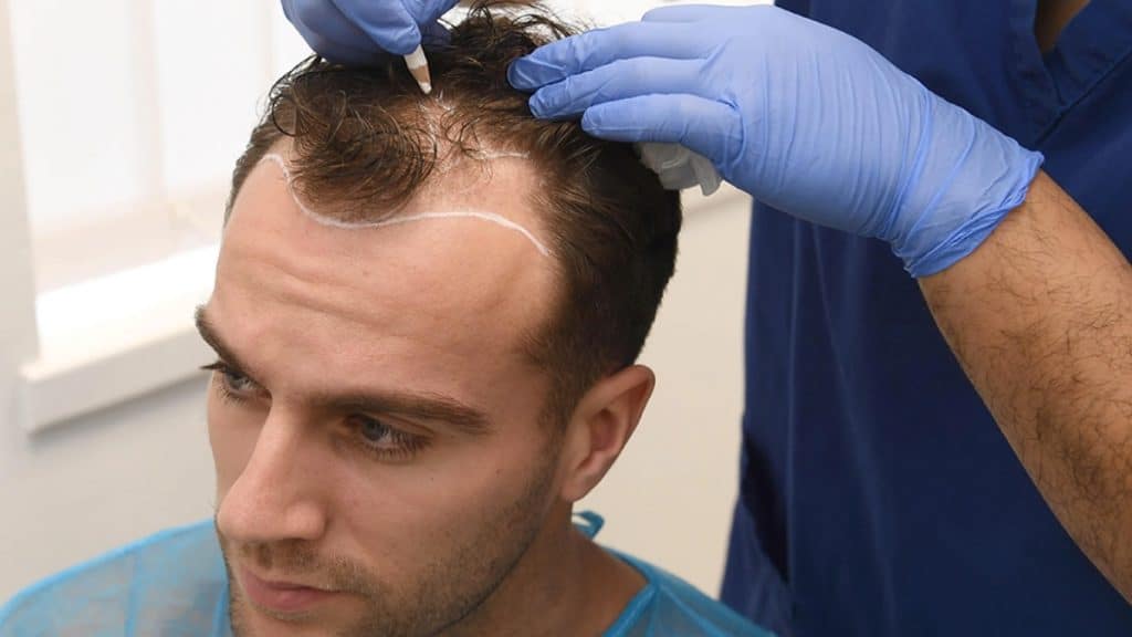 Transform Your Hairline Discover the Best Turkey Hair Transplant Before and After