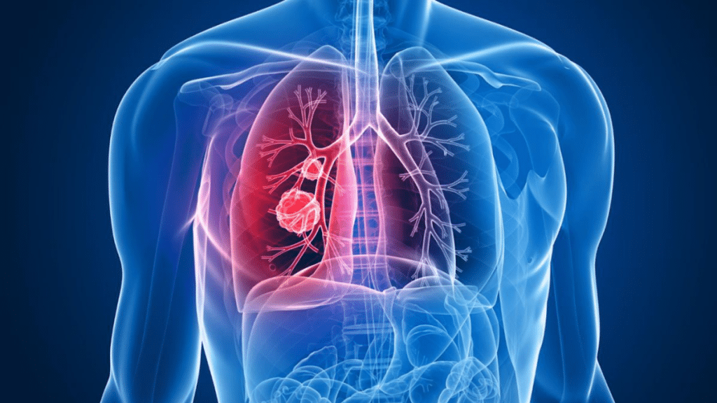 Lung Cancer Symptoms in Non-Smokers What You Should Be Aware Of