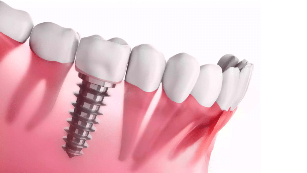 5 Cost Drivers of Dental Implants in Turkey What You Should Know