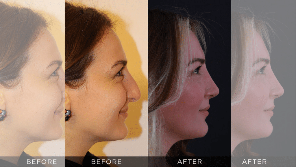 Cutting-Edge Techniques for the Best Rhinoplasty Results in Turkey