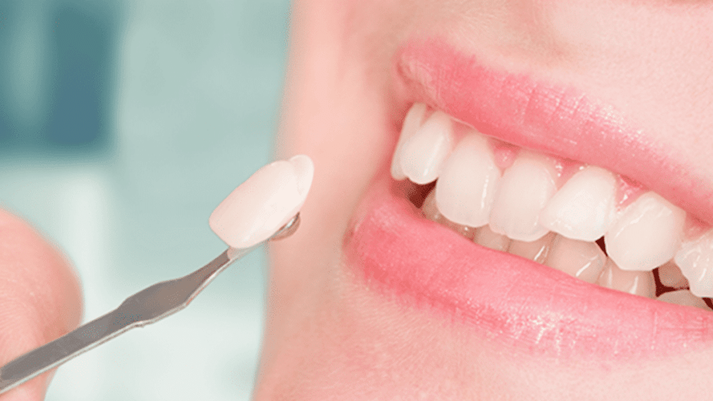 How Dental Veneers Will Change Your Smile?