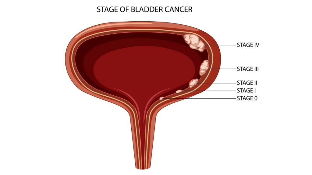 Understanding Bladder Cancer Symptoms, Treatment Options, and Prevention