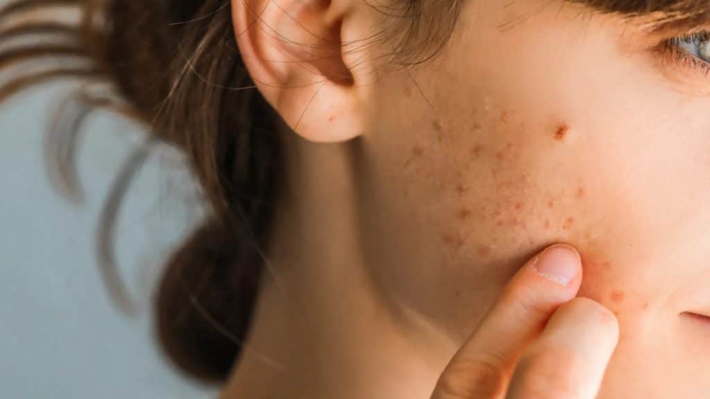 Why Is My Acne Getting Worse Even Though I Take Care of My Skin?