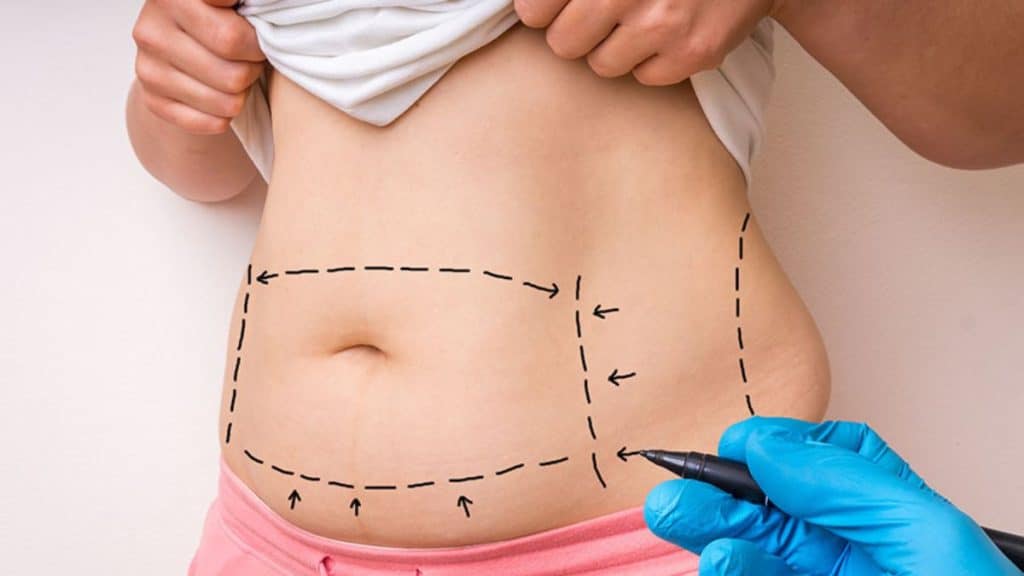 Finding the Right Tummy Tuck Surgeon