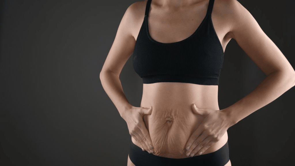 How to Prevent Loose Skin After Weight Loss