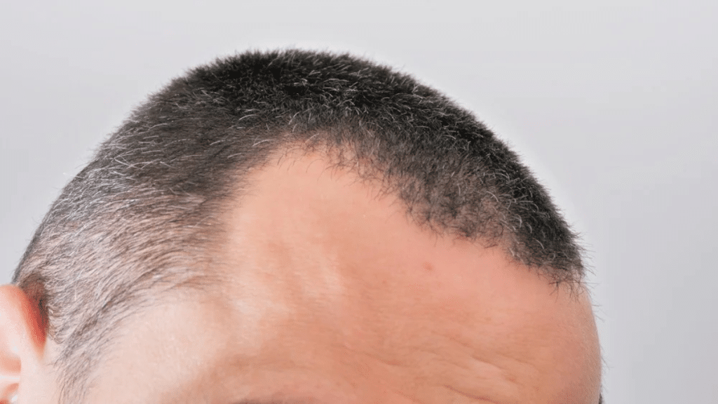 Male Hair Loss Understanding the Causes and Permanent Solutions