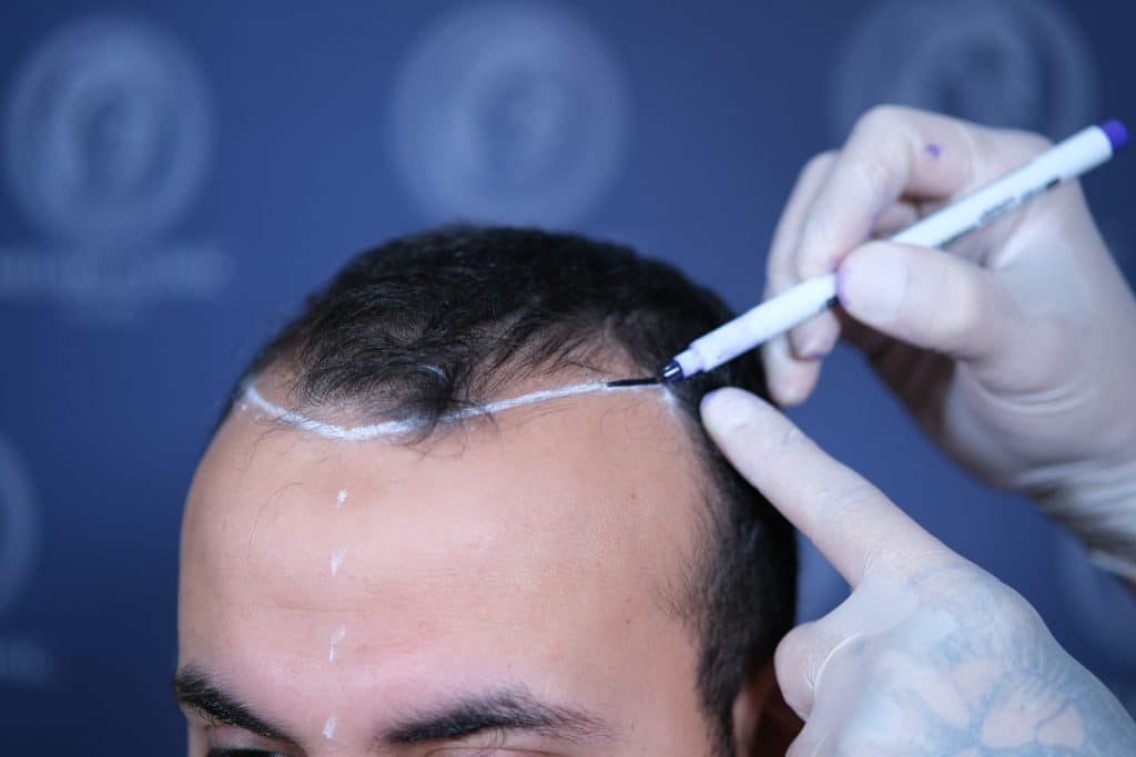 Male Hair Loss: Understanding the Causes and Permanent Solutions