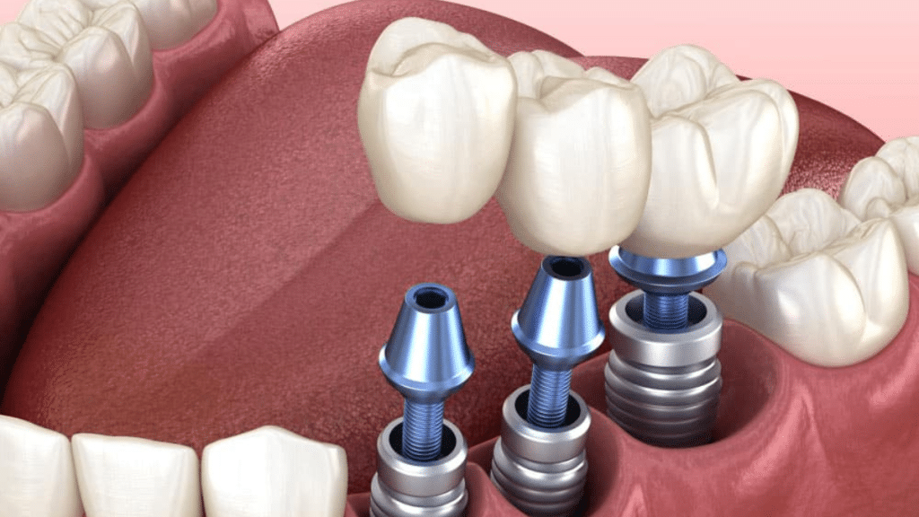The Future of Tooth Replacement How Technology is Reshaping Dental Implants