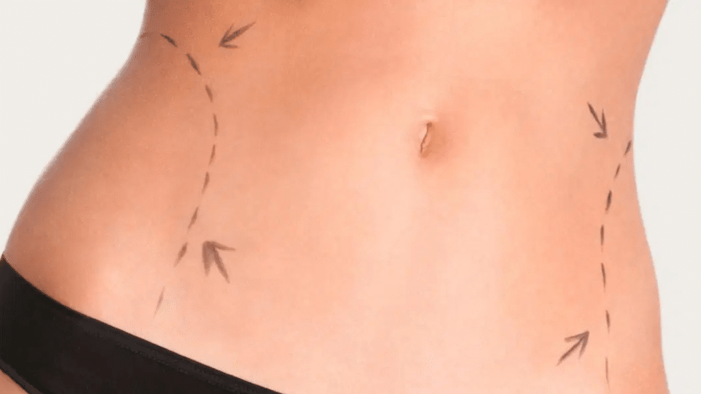 Things Most People Regret Not Knowing Before Liposuction