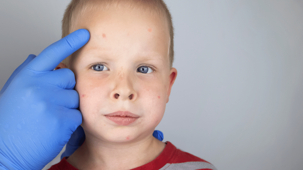 Child with allergy symptoms - pediatric allergist advice