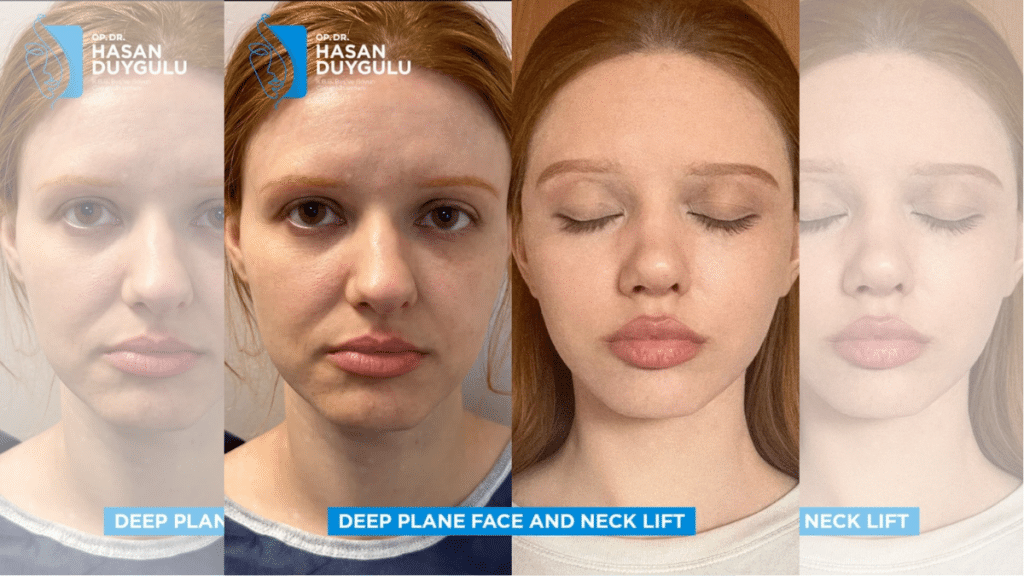 Facelift in Turkey Why Rhytidectomy is Thriving in a Global Hub