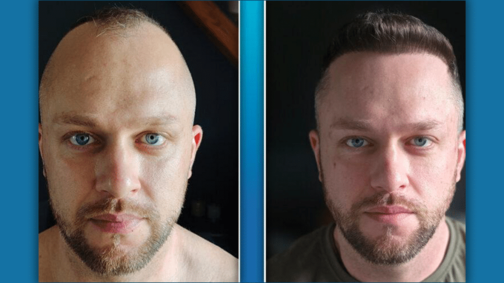 Poles Are Heading to Turkey for Hair Transplants and Hollywood Smiles — and They’re Taking MediTravel With Them