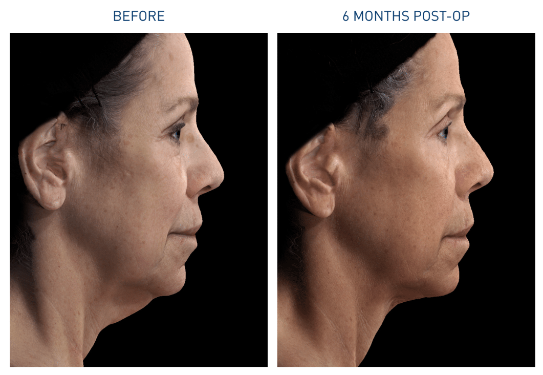 Renuvion procedure