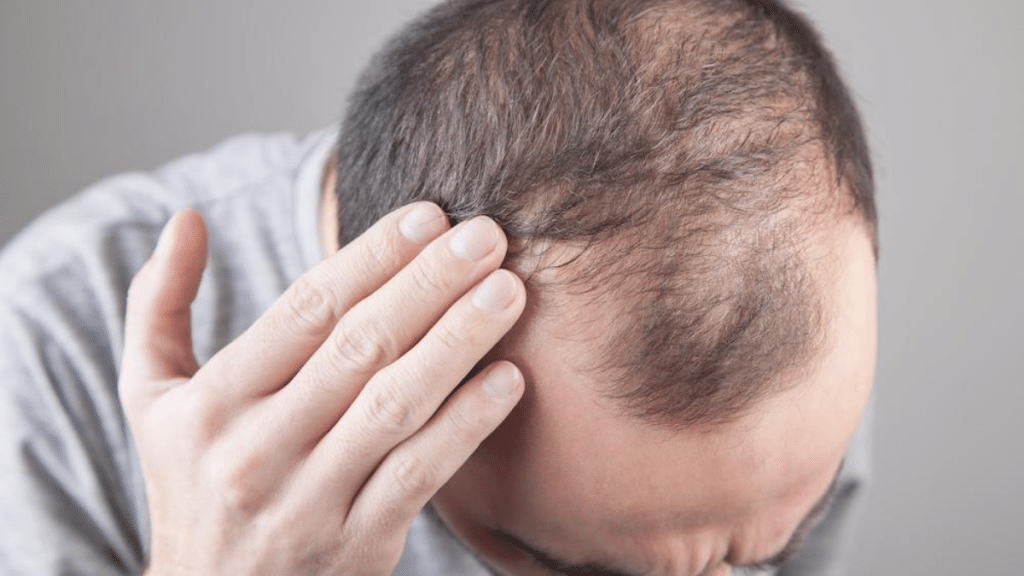 What Causes Hair Loss and How to Deal With It