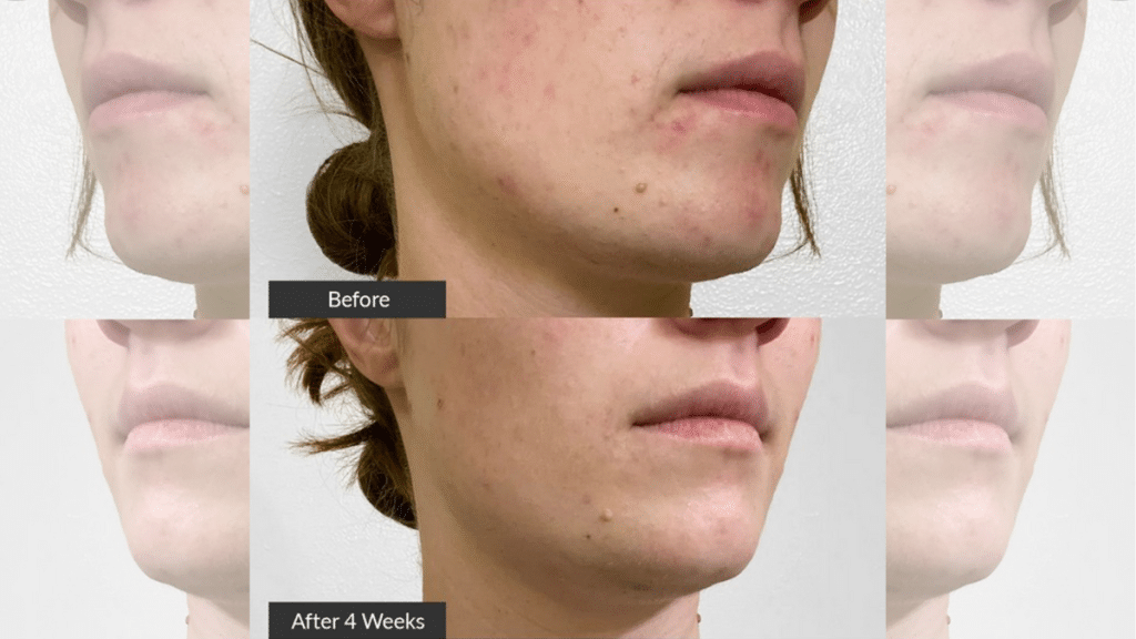 How to Develop an Effective Clean Acne Skin Care Routine?