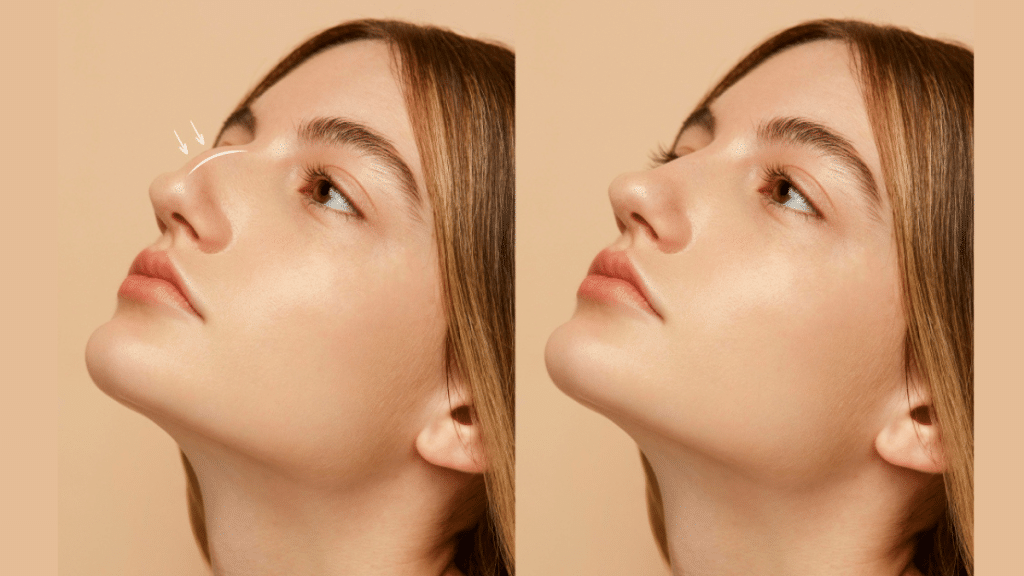 Revision Rhinoplasty in Turkey A Comprehensive Guide to Costs, Surgeons, and Recovery