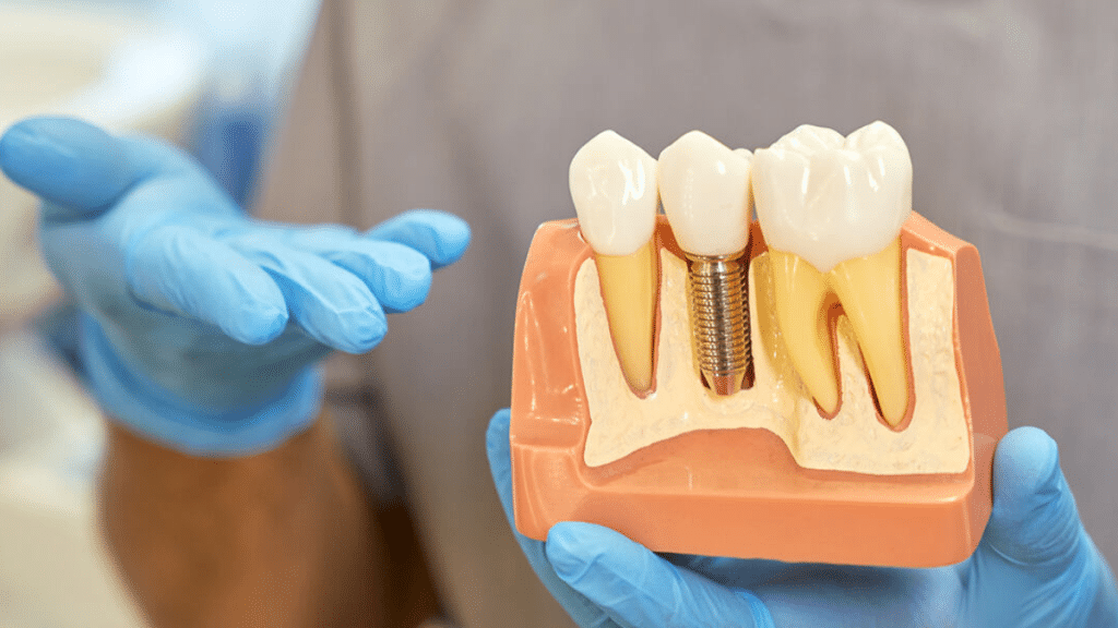 The Long-Term Benefits of Dental Implants You Should Know About